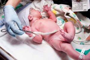 Prolapsed Umbilical Cord and Birth Injuries