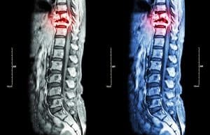 Spinal Cord Injuries: Why the Real Cost of Spinal Cord Injuries Is Often More Than You Think